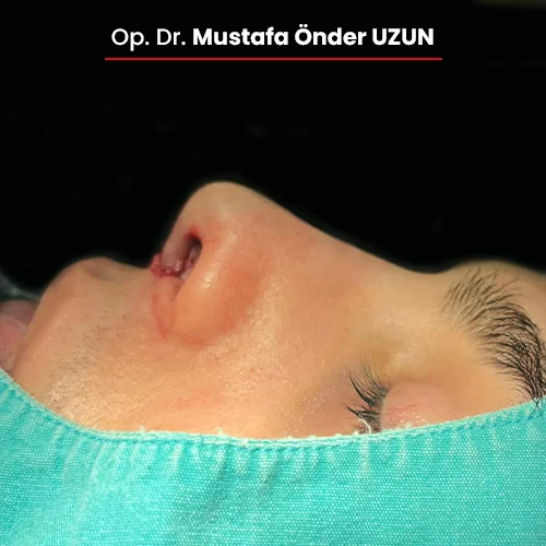 Öncesi Sonrası 76641736