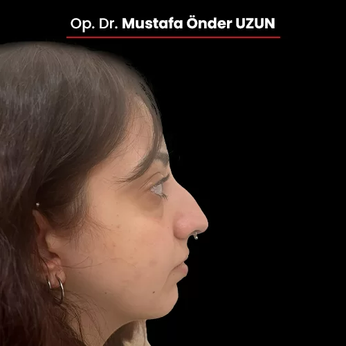 Öncesi Sonrası 1399603713