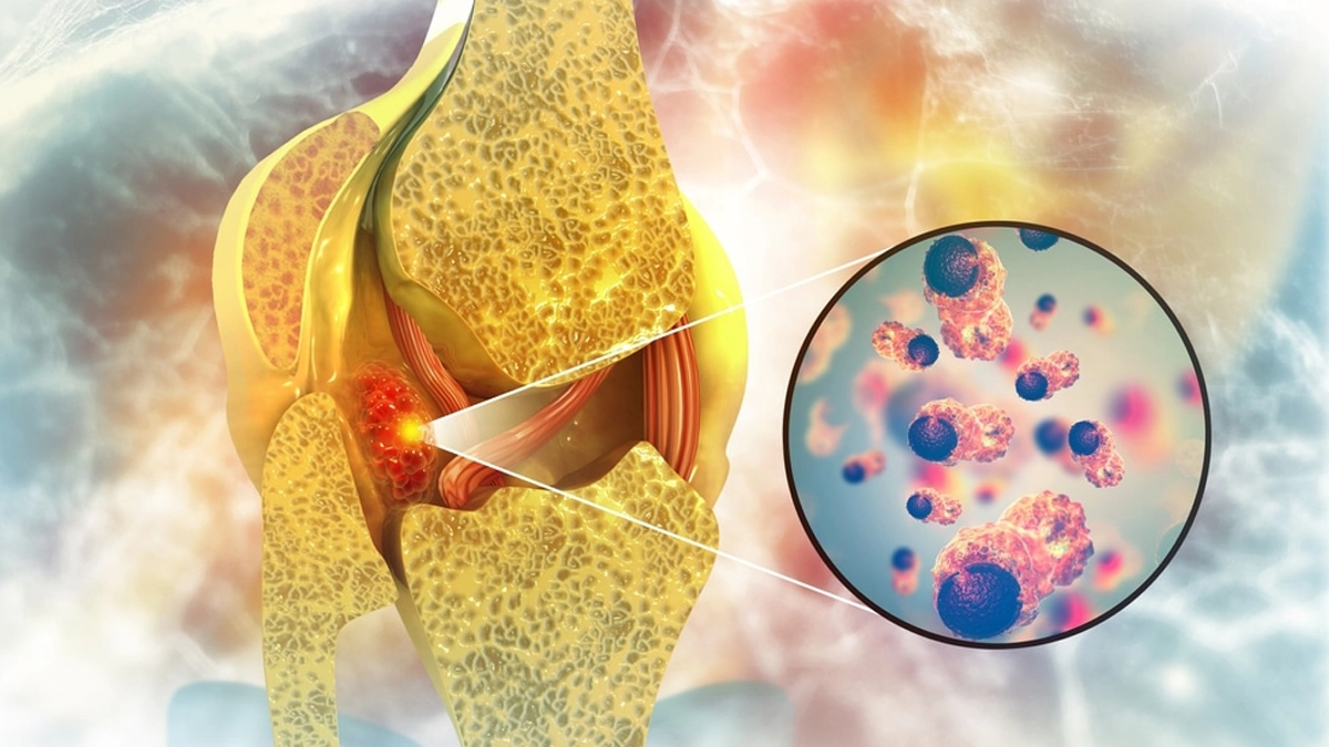 Kemik Tümörü Nedir?